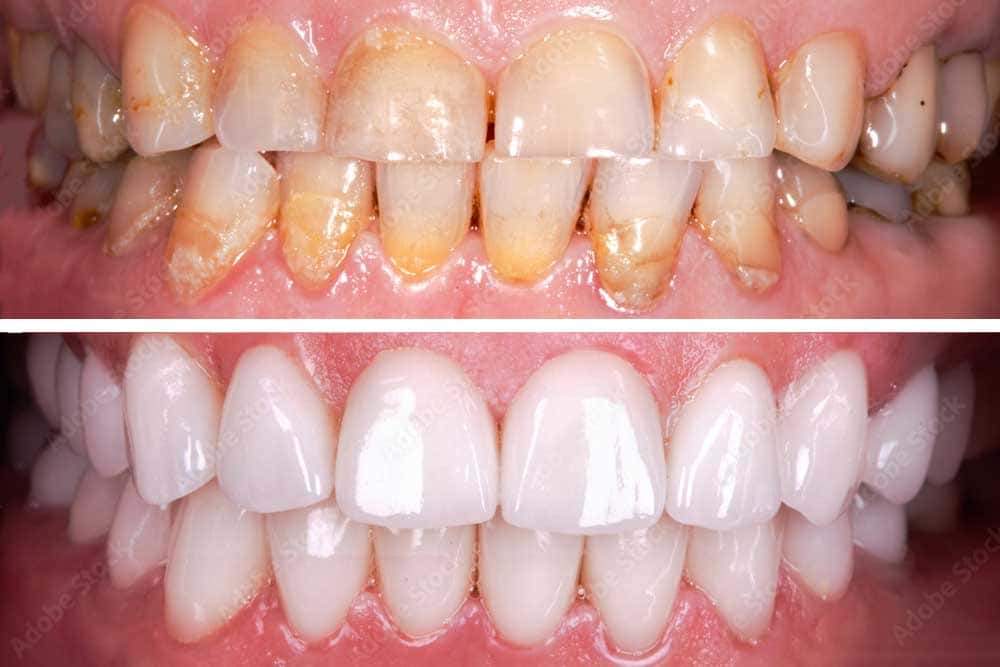 crown implants before and after