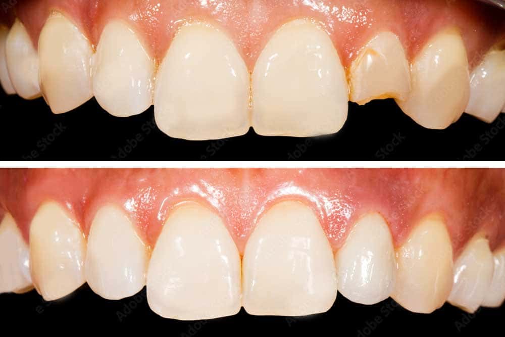 prosthetic tooth replacement before and after